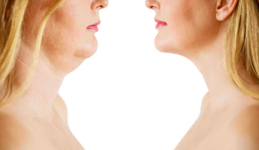 Double Chin treatment Sydenham before and after results