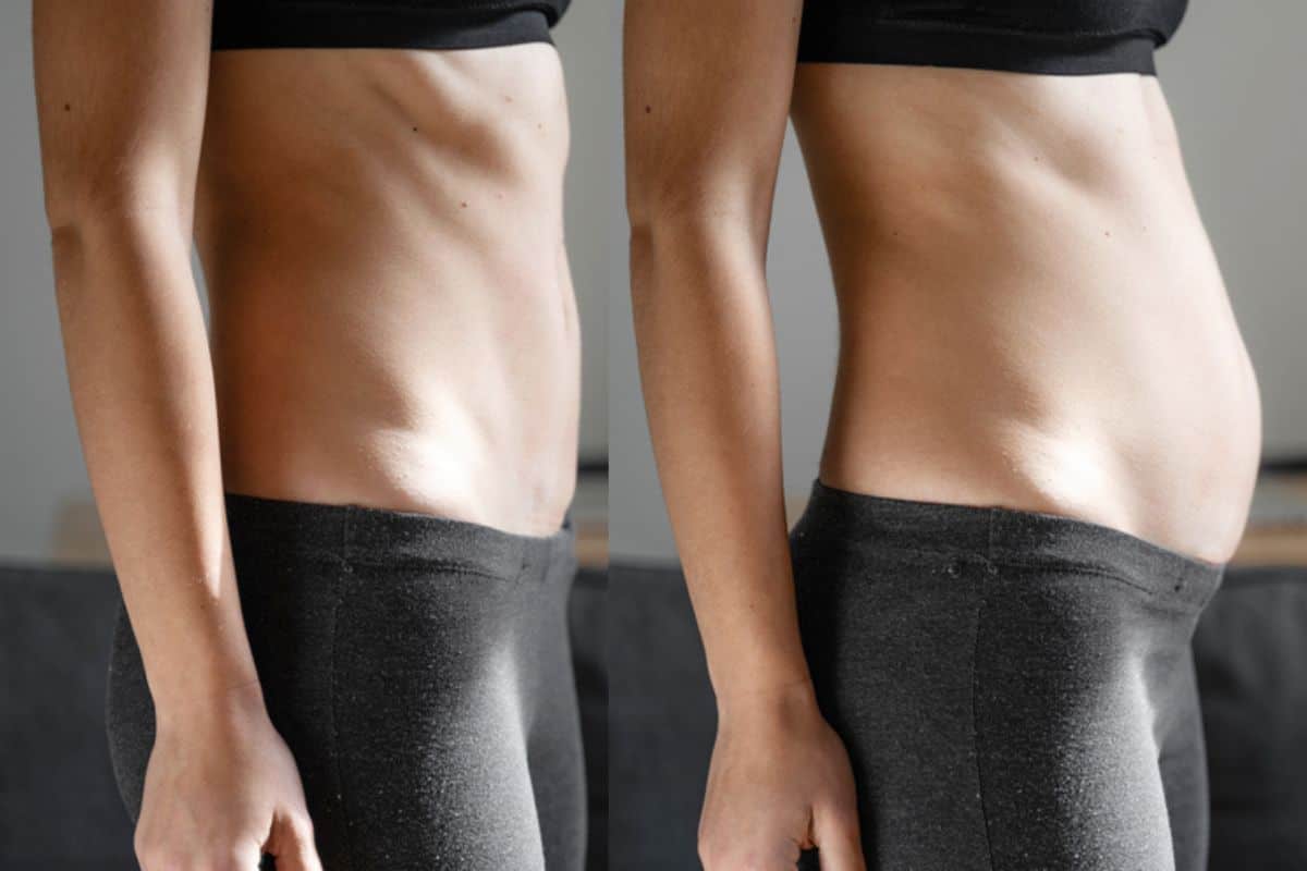 How long does diastasis recti take to improve Sydenham?