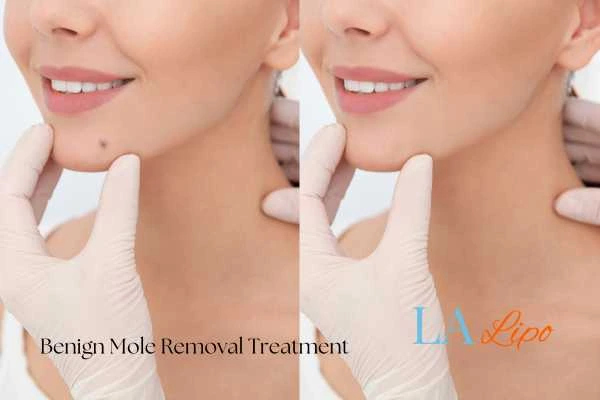 Before-and-after results following benign mole-removal treatment Sydenham
