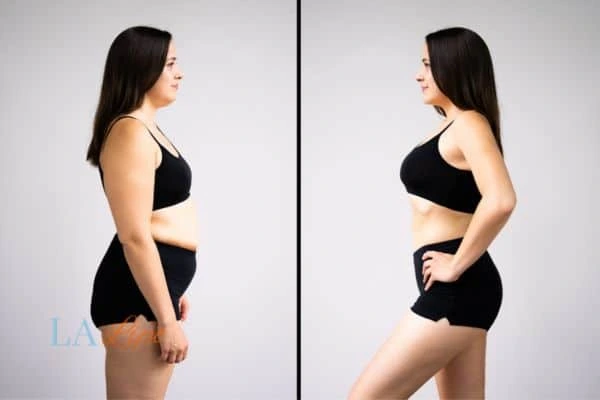 image of woman before and after results of LA-EMS Body Sculpting Sydenham to help treat Diastasis recti