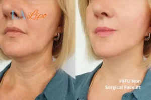 hi-fu for wrinkles Sydenham before and after results