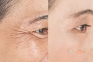 Before and after results of woman - HI-fu wrinkles reduction treatment Sydenham
