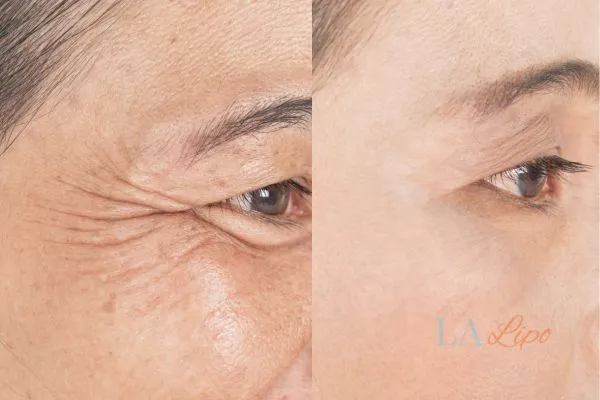 Before and after results of woman - HI-fu wrinkles reduction treatment Sydenham