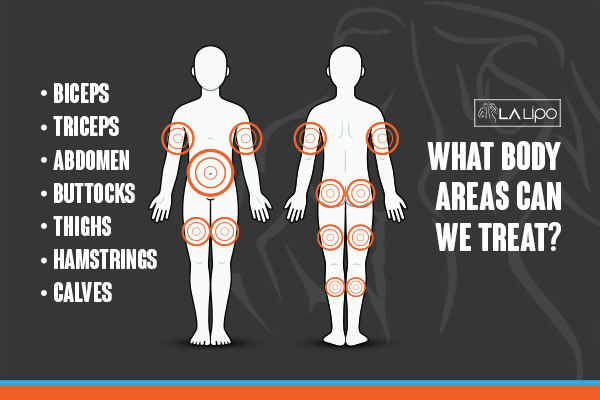 Graphic to show areas you can have LA-EMS Body Sculpting Sydenham treatment.