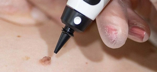 skin tag removal using cryopen Sydenham