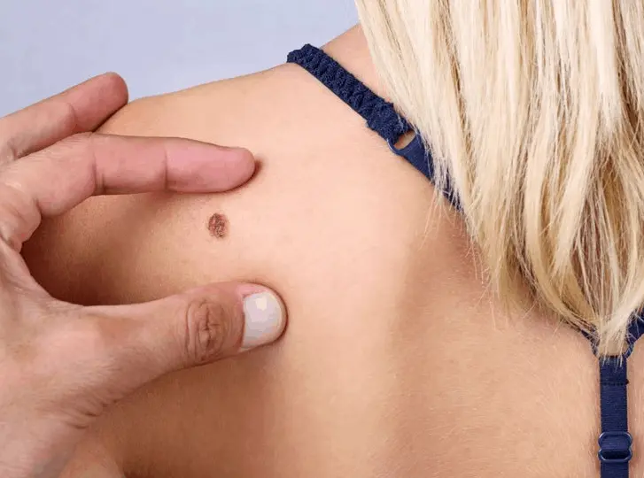 woman having mole removal Sydenham consultation before treatment.