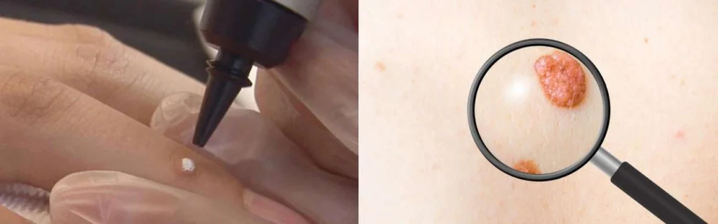 CryoPen practitioner Sydenham assessing a benign mole before treatment