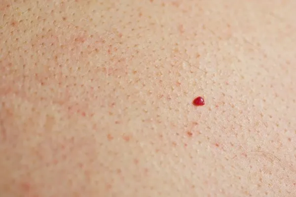 close up of a cherry angioma Sydenham