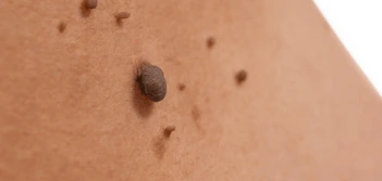image of a skin tag Sydenham