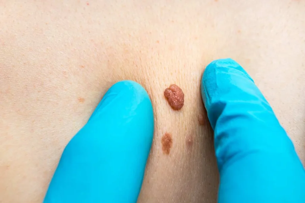 Consultant examining a skin tag Sydenham
