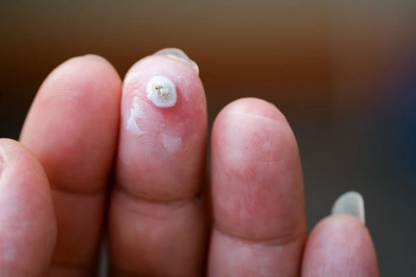wart on person finger - cryotherapy to treat from LA LIPO Sydenham
