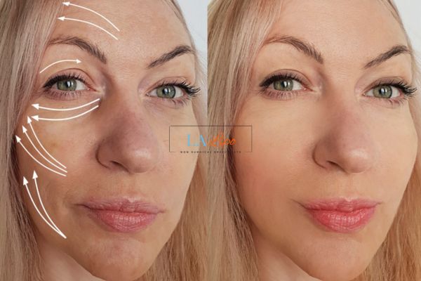 Morpheus 8 results Sydenham face lift.