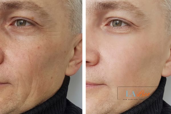 See the amazing results of Morpheus8 Treatment Sydenham!