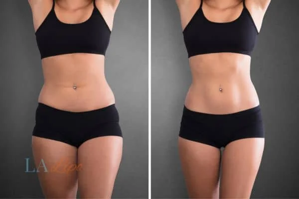 before and after results of non-surgical treatment to help a woman's body image and mental health Sydenham