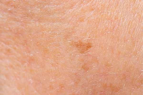 close up picture of age spots Sydenham
