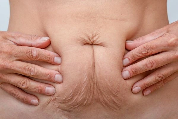 Should I Combine Diastasis Recti Treatment with Body Contouring for Better Results Sydenham?