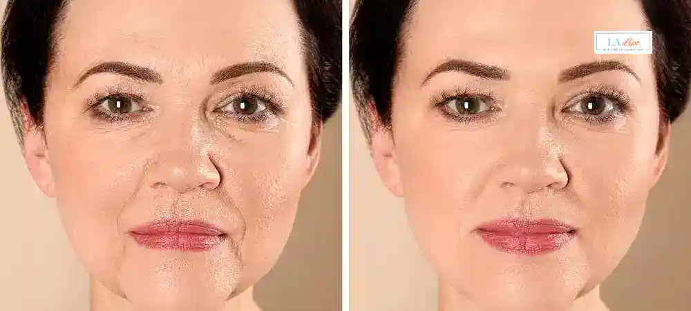 How Long Does It Take to See Results and How Long Do They Last Sydenham?