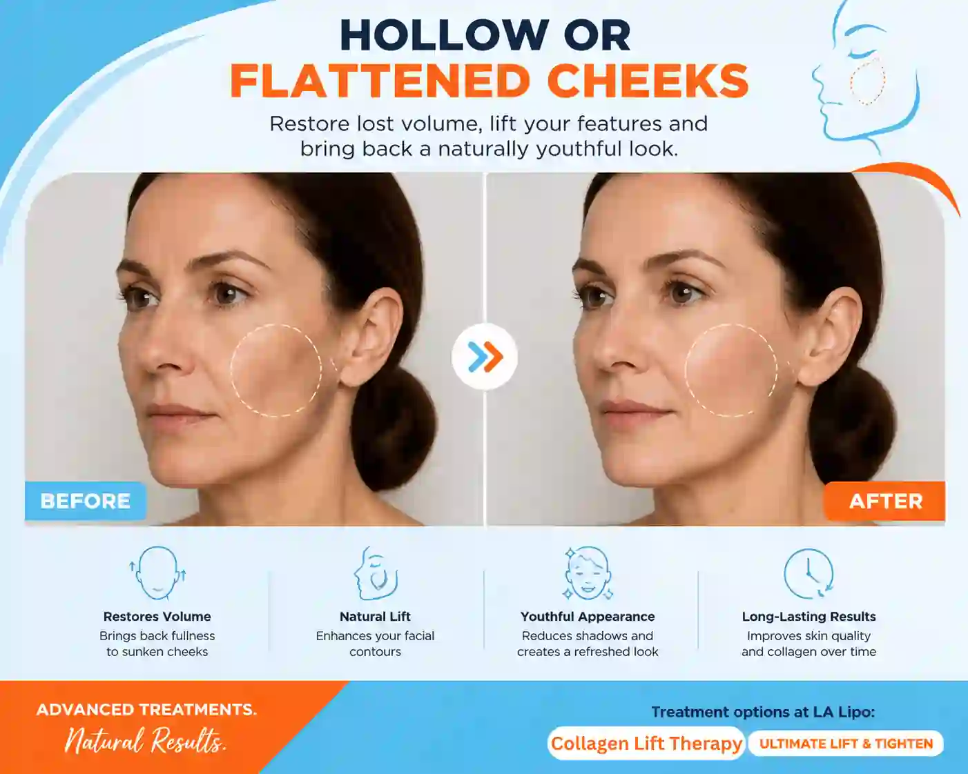 Sign #4: Hollow or Flattened Cheeks Sydenham