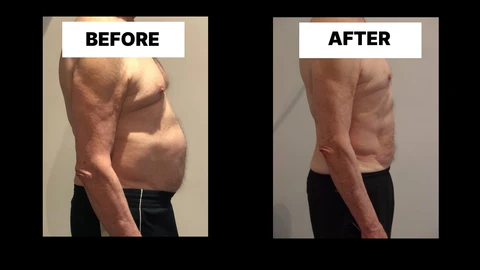 What Symptoms Can Diastasis Recti Cause in Men? Weak Core, Back Pain and Poor Posture Sydenham